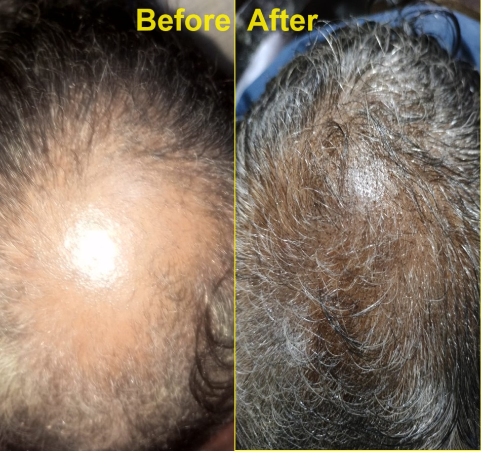 Before After - Real Patient Result