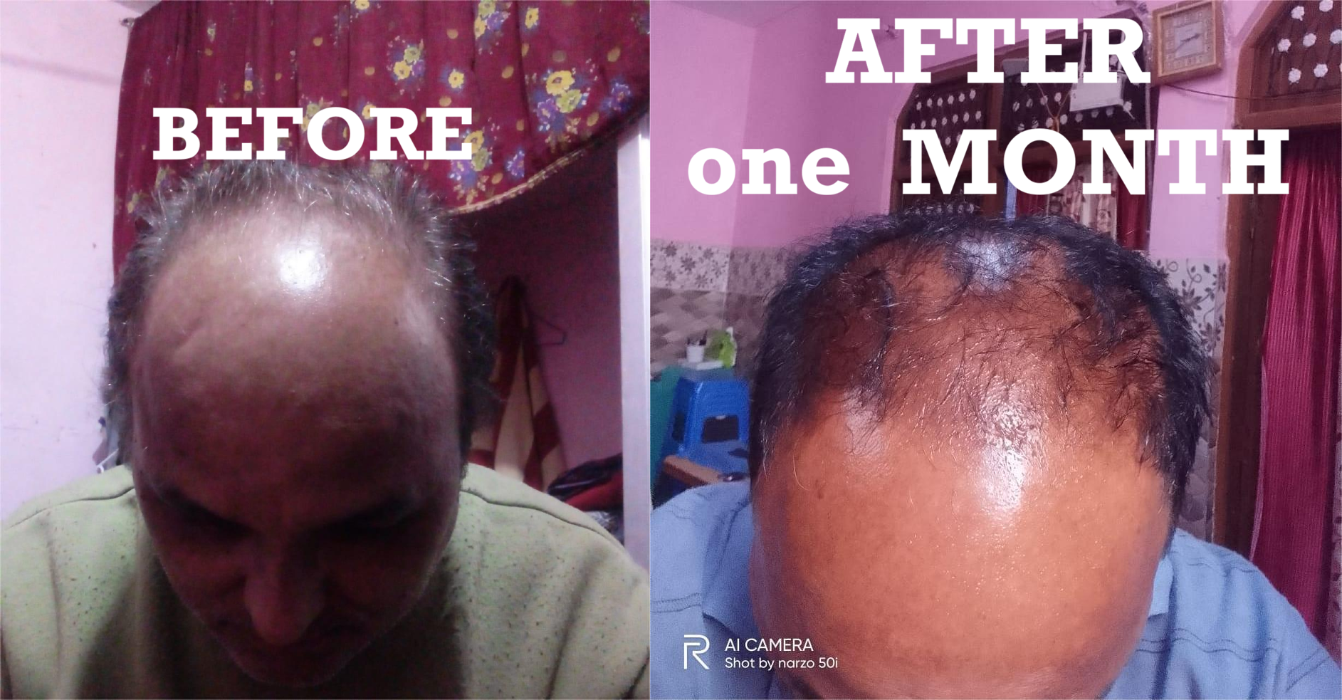Before After - 1 Month Trichora Response
